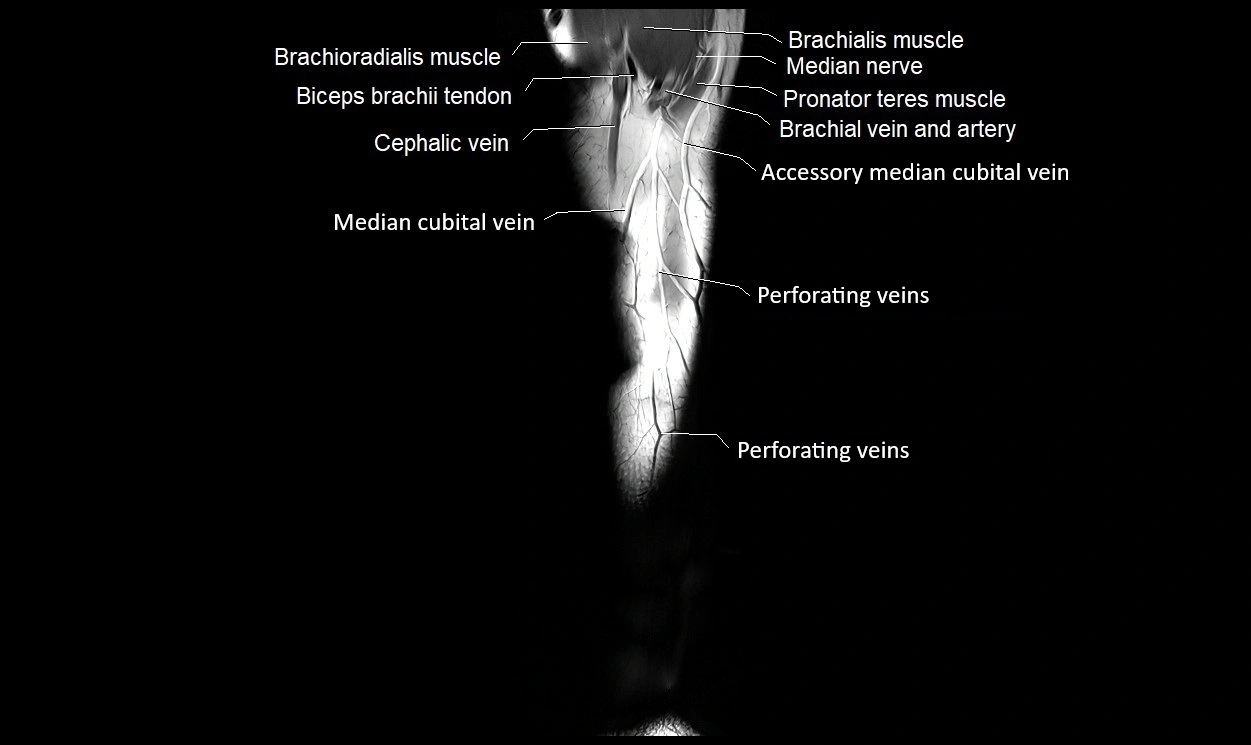 MRI 3T forearm coronal cross sectional anatomy image 3.webp